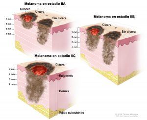 Так выглядит меланома на стадии A, B и C.