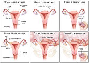 Таблица 29-6. Классификация рака яичников по стадиям
