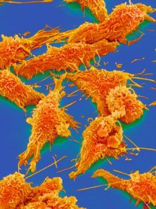Клетки рака толстой кишки. (Фото Micro Discovery / Corbis.)